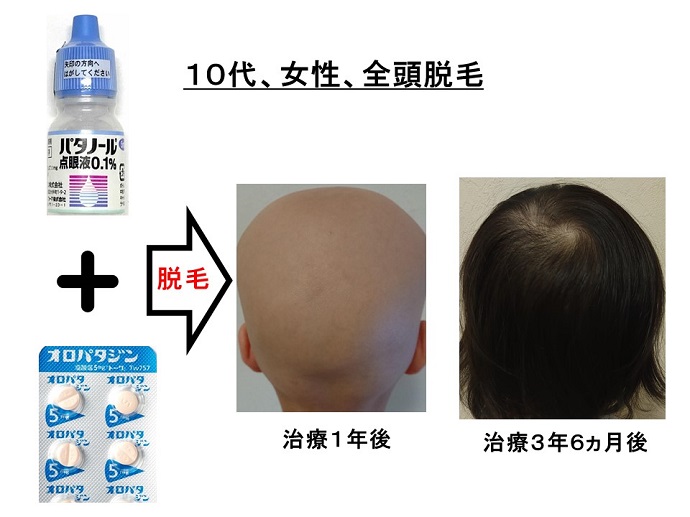 円形脱毛症　病院